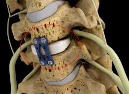 Anterior cervical discectomy and fusion