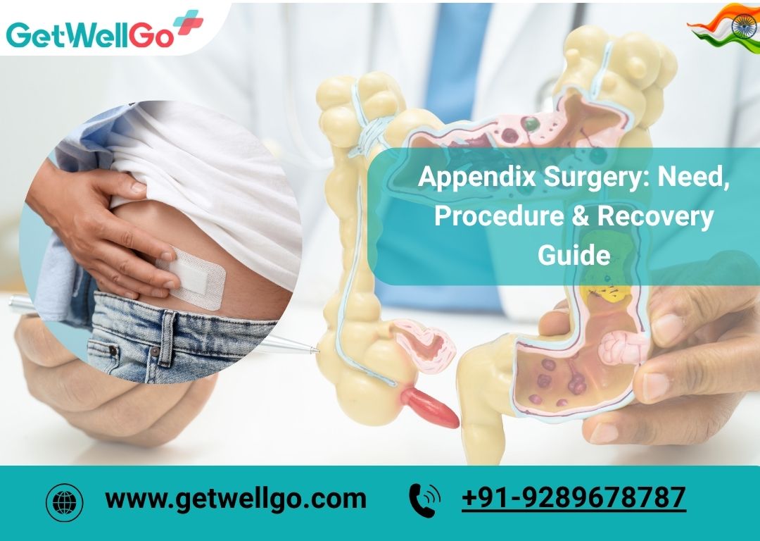 Appendix Surgery: Need, Procedure & Recovery Guide
