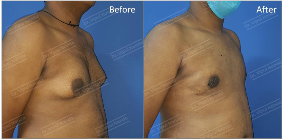 Breast surgery by Dr. Vipul Nanda