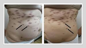 Castleman Disease Treatment
