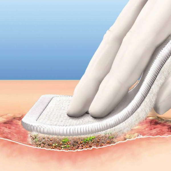 Debridement