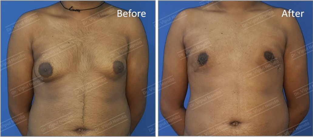 Dr. Vipul Nanda Breast surgery