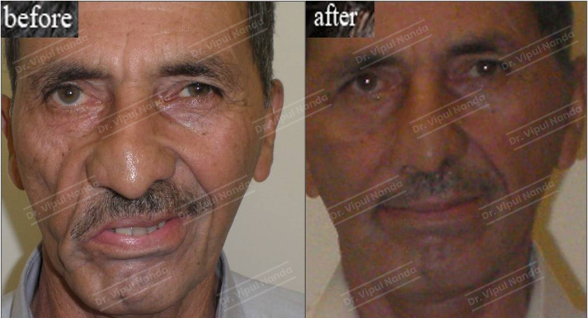 Dr. Vipul Nanda Face lift surgery