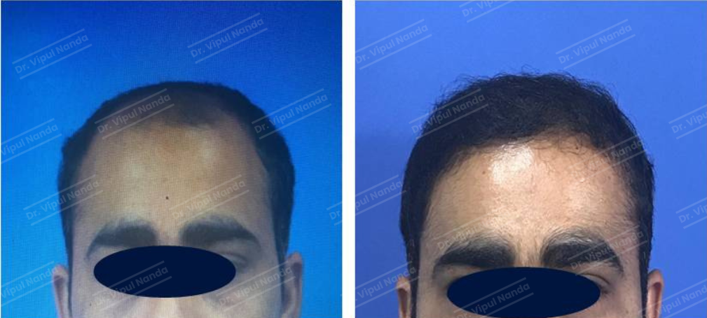 Dr. Vipul Nanda Hair Transplant