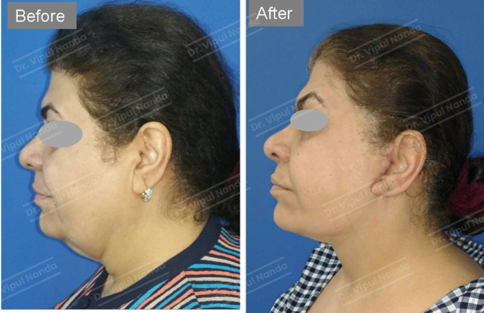Dr. Vipul Nanda Scar Treatment