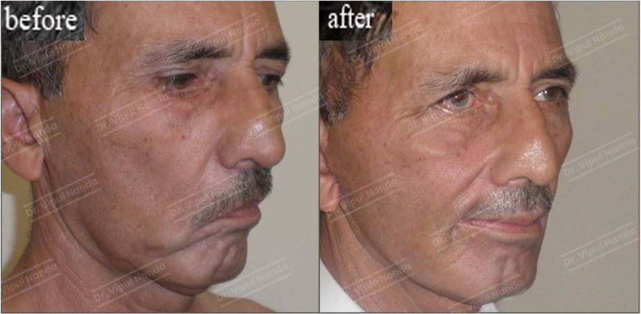Face lift surgery by Dr. Vipul Nanda