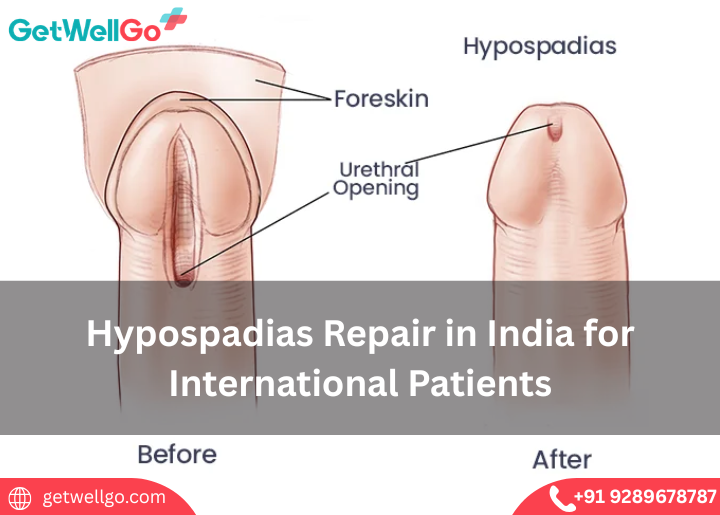 Hypospadias Repair in India for International Patients