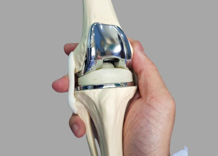 Knee Replacement Surgery Package Turkey