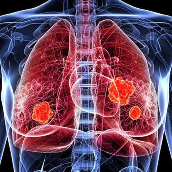 Lung transplant in India