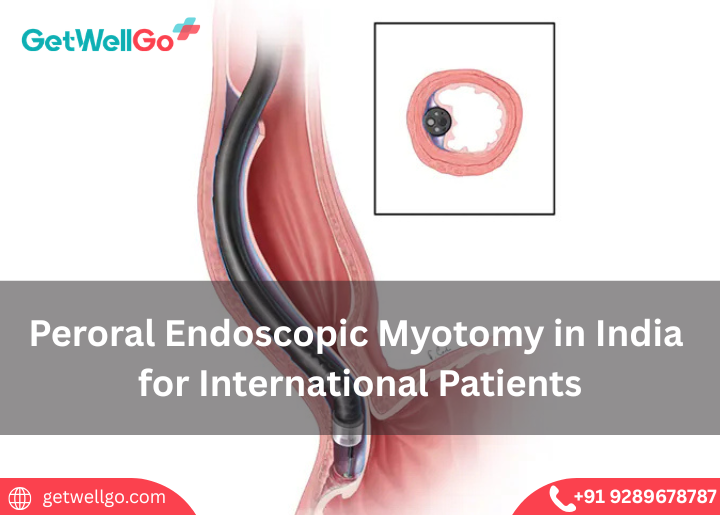 Peroral Endoscopic Myotomy in India ​for International Patients​
