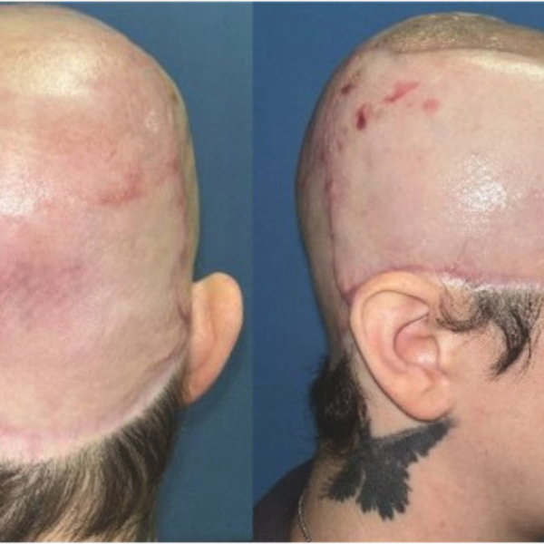 Scalp Avulsion