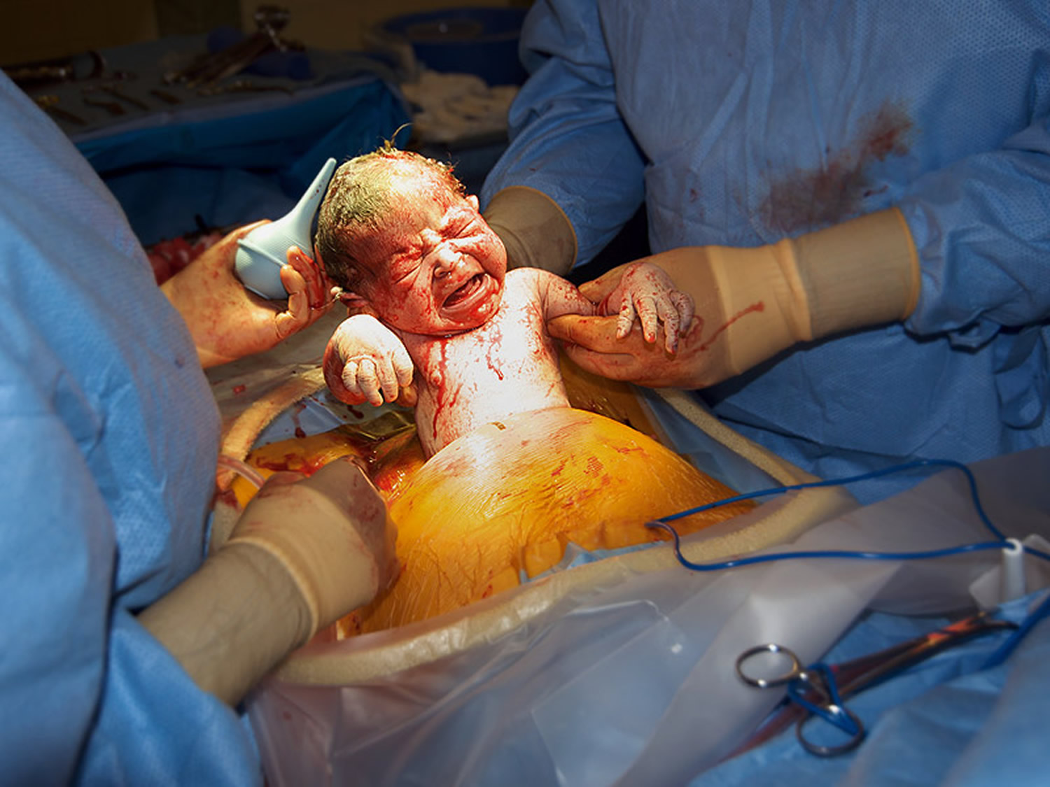 C - section - Cesarean delivery in live (Full) 