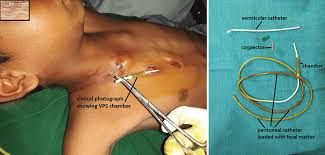 Ventriculoperitoneal Shunt procedure